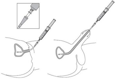 Instillatie van een medicijnoplossing in urethra