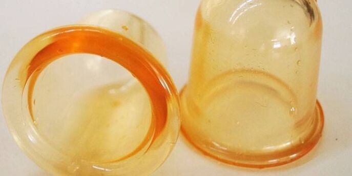 cups voor de behandeling van prostatitis