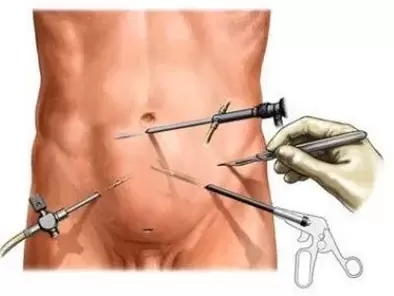 chirurgische behandeling van chronische prostatitis