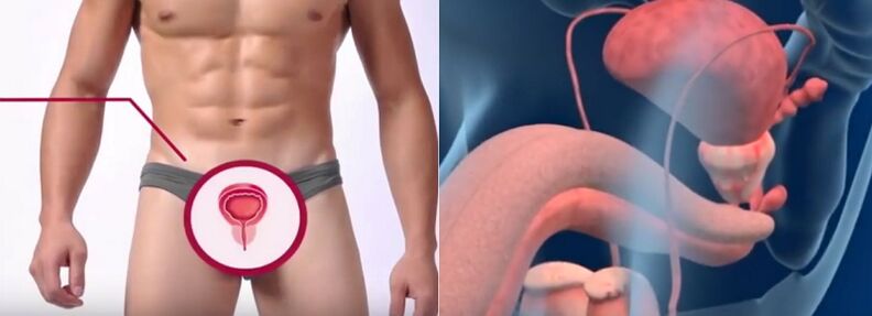 Prostatitis bij mannen, herkenbaar aan bepaalde symptomen