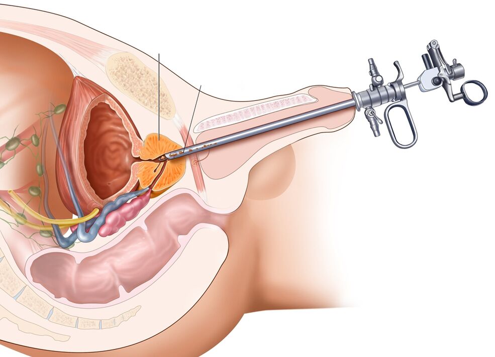 Met transurethrale resectie van de prostaat kunt u de aangetaste delen van het orgaan verwijderen