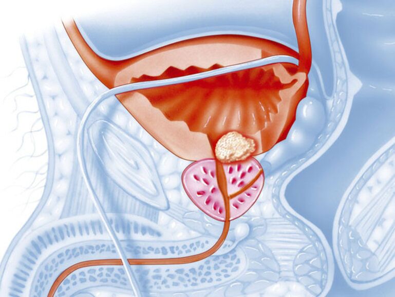 Bij chronische prostatitis vernauwt het lumen van de urethra zich, waardoor de urine moeilijk kan wegvloeien. 